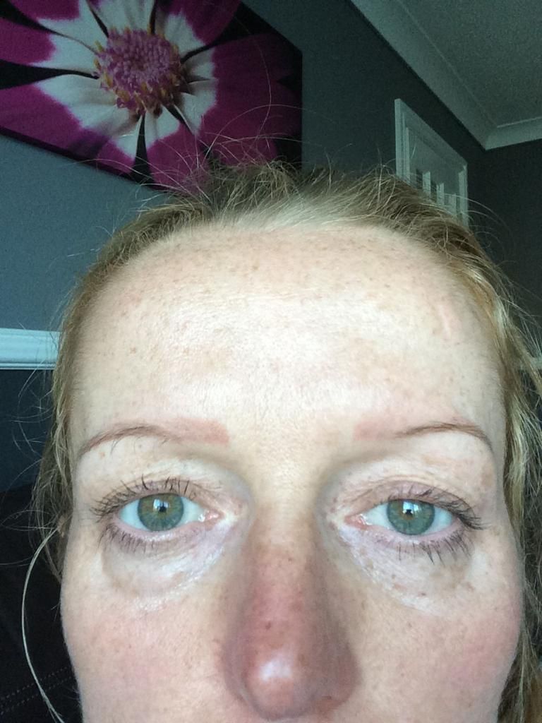 A picture of a female client before an eyebrow hair transplant in Edinburgh