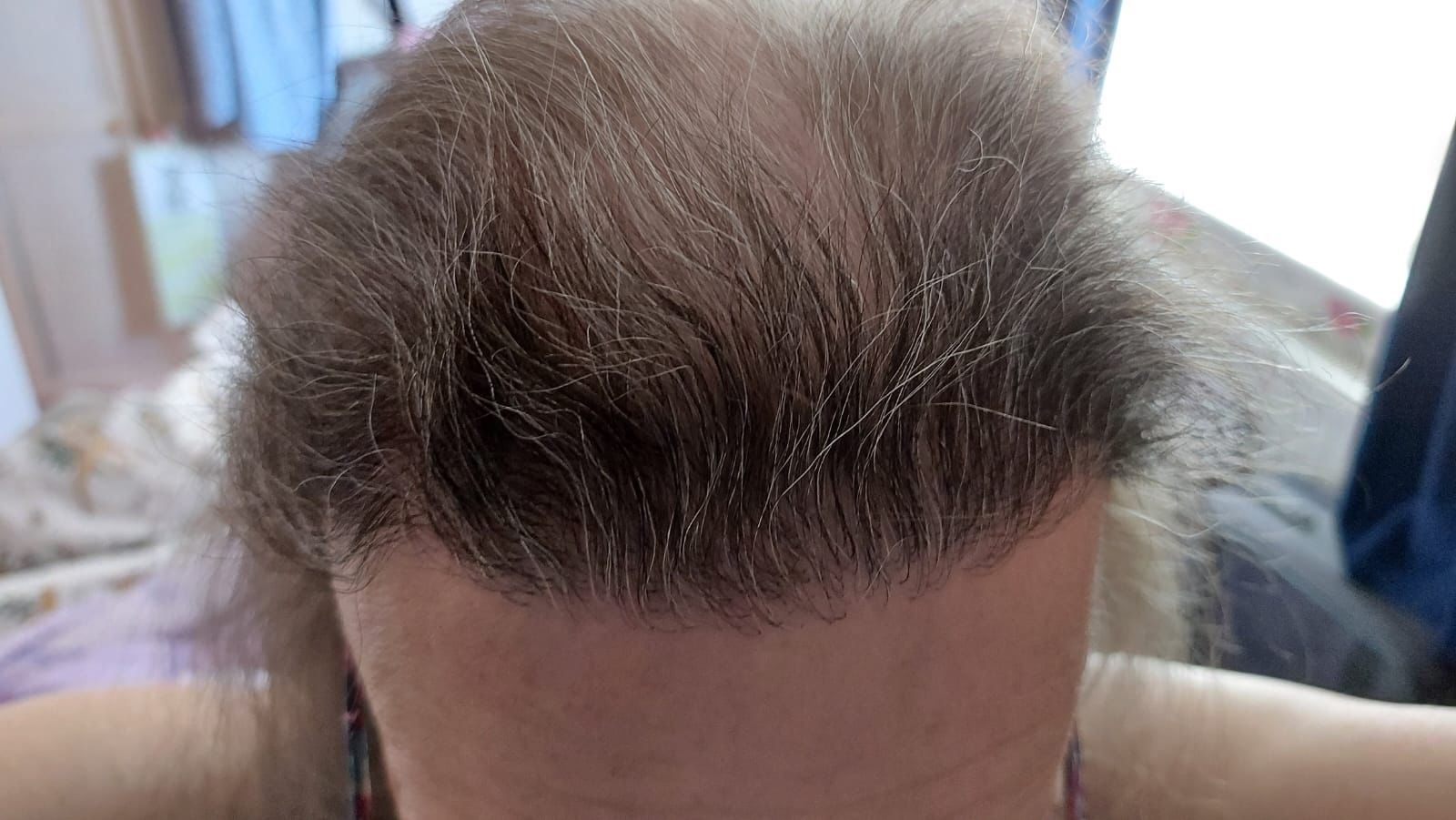 A picture of a transgender patient after a hair transplant