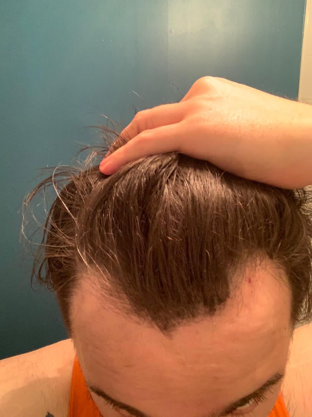 A picture of a patient showing signs of male pattern baldness