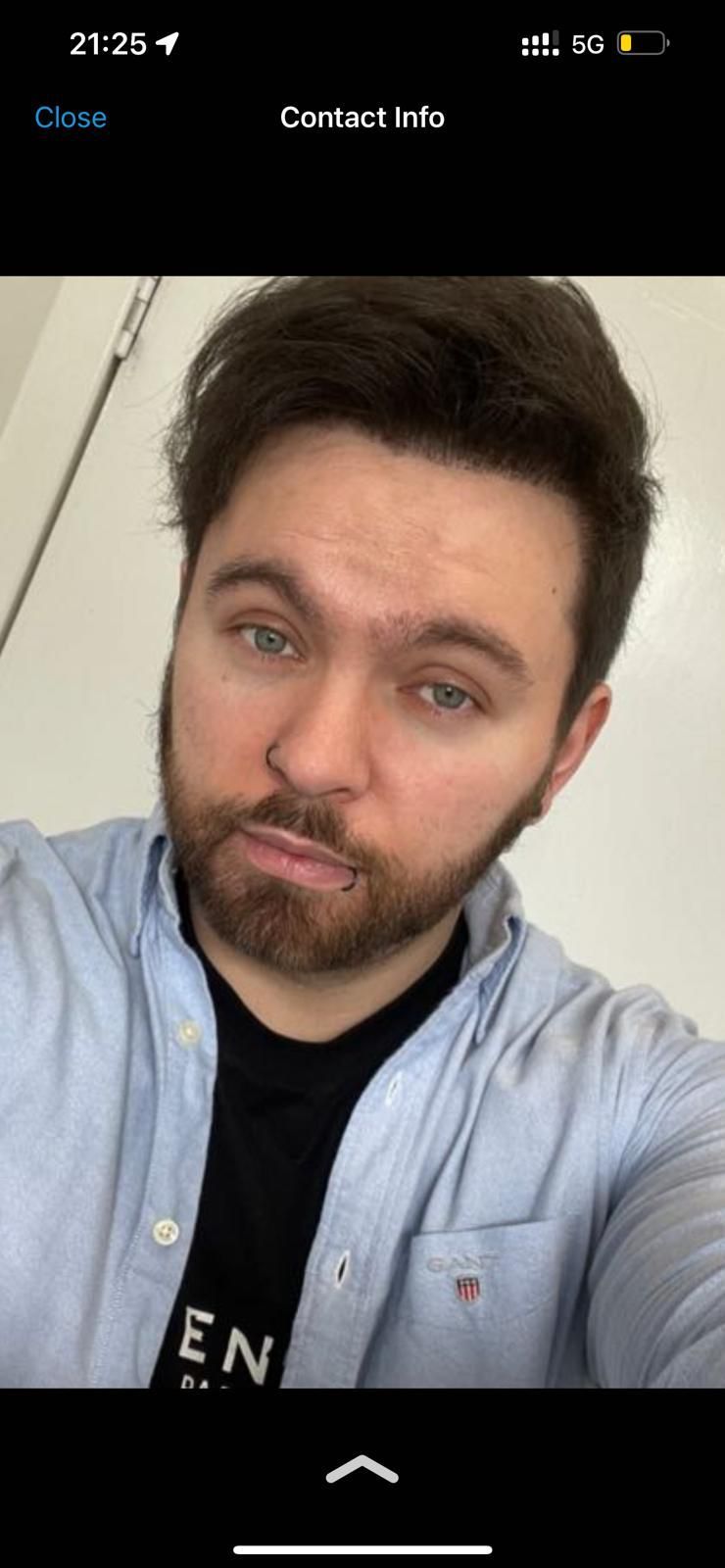 A picture of a patient after undergoing FUE at Harley Street Hair Transplant Edinburgh