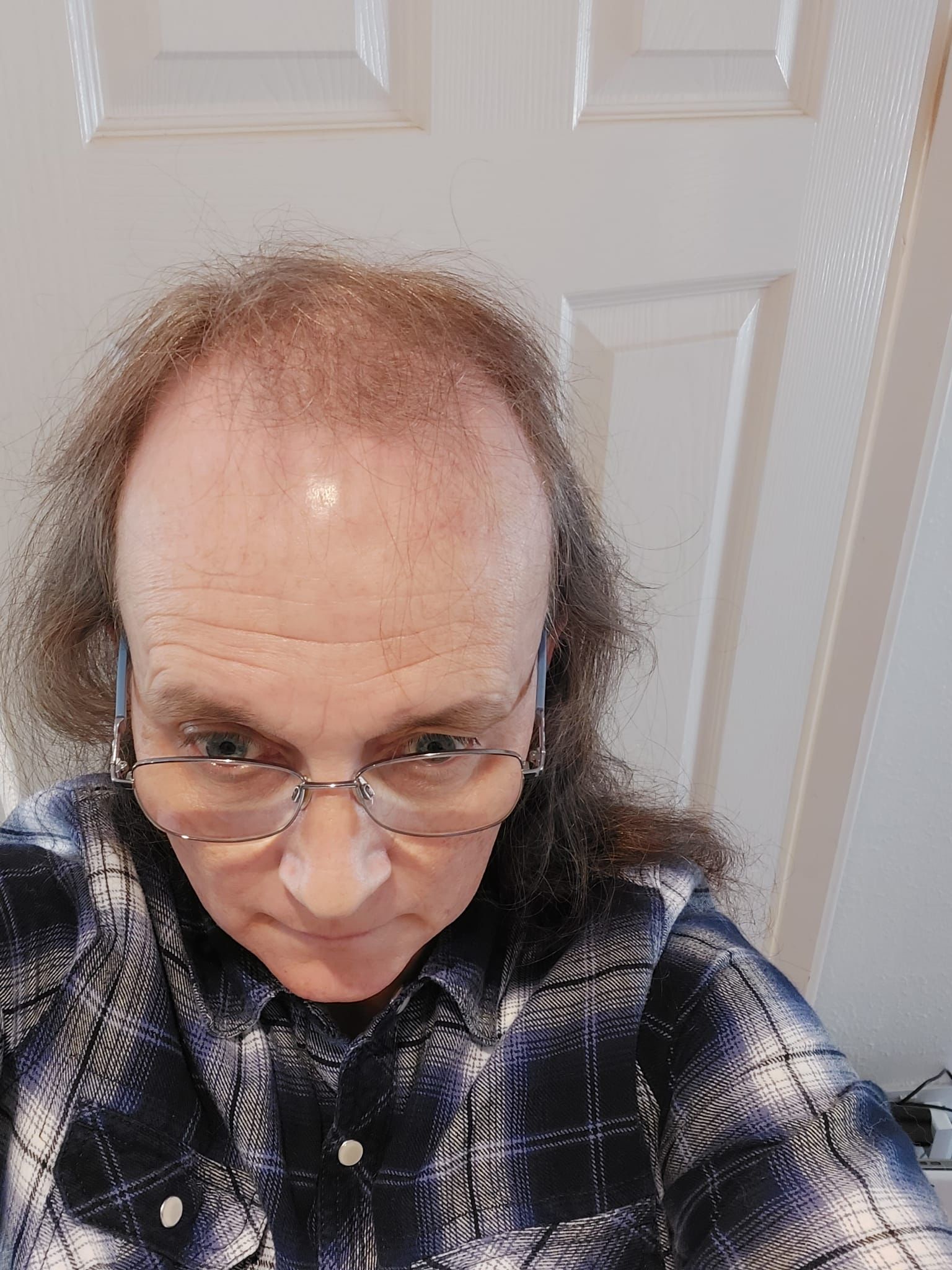 A picture of a transgender patient before a hair transplant