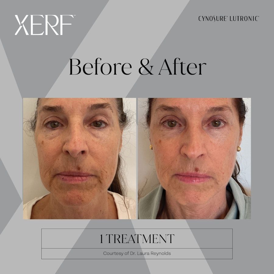 XERF Before and After 