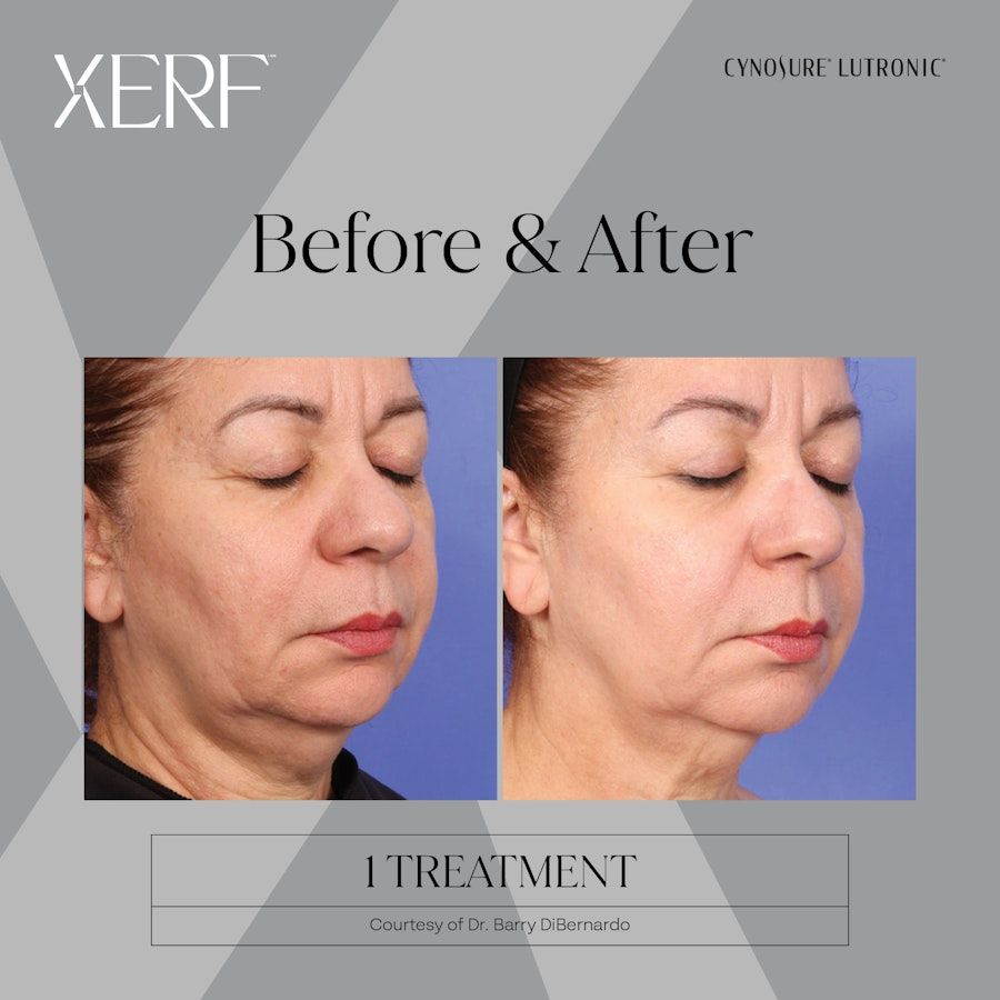 SERF Skin Tightening Before and After