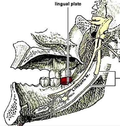 tratar uma lesão do nervo lingual