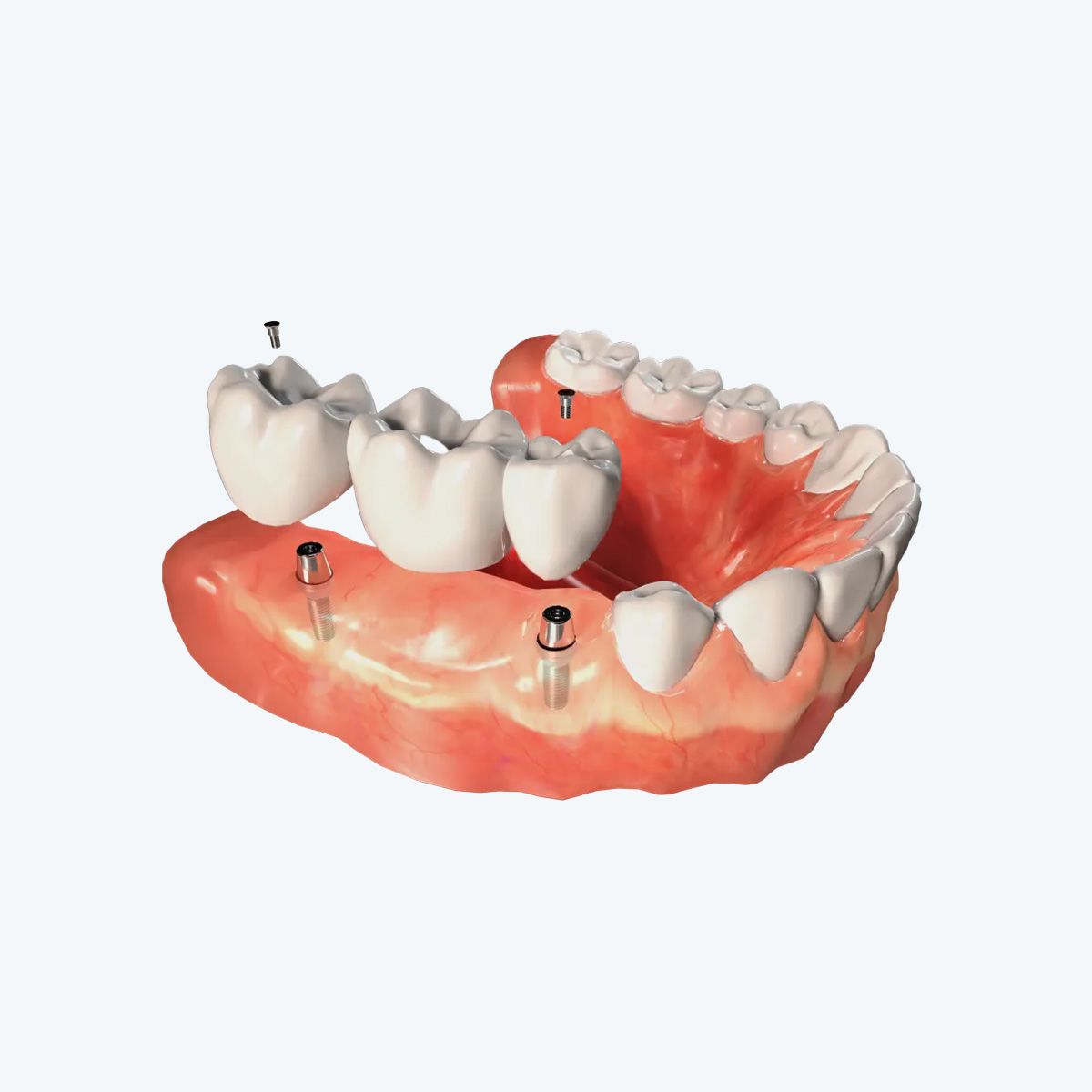 A model of a denture with dental implants in it