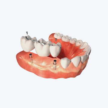 A model of a denture with dental implants in it