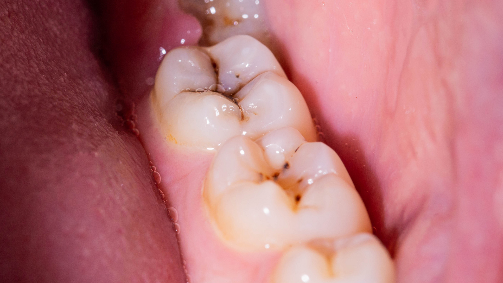 Close-up of teeth with several brown cavities, set against the pink mouth interior.