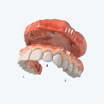 A 3d model of a full denture with dental implants.