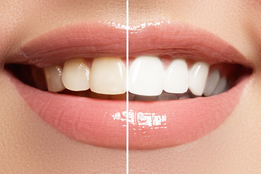 Close-up of a mouth; before and after teeth whitening. Left side: yellow teeth. Right side: bright white teeth.