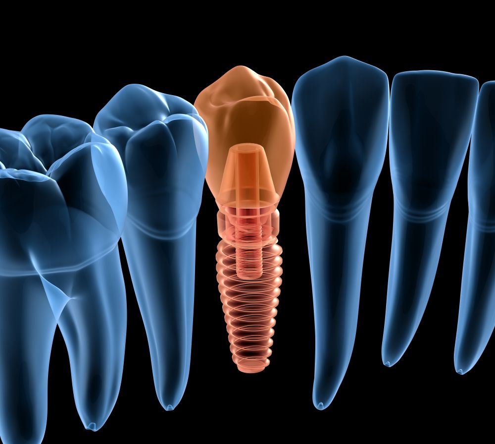 X-ray view of teeth, highlighting a dental implant with a screw and crown.