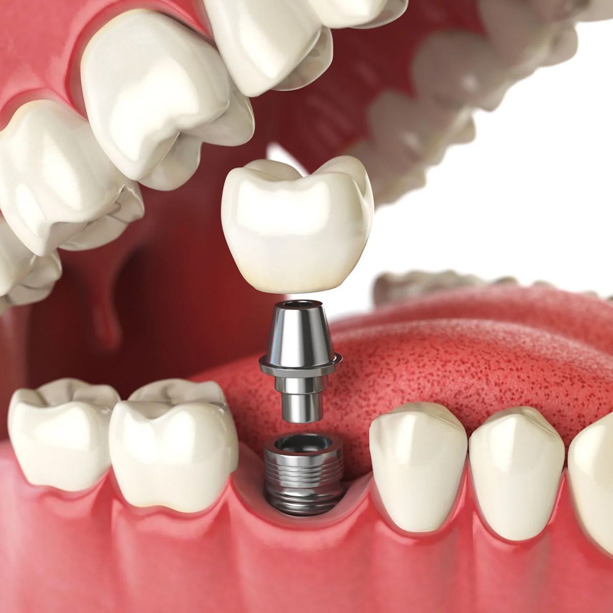 A close up of a dental implant in a person 's mouth.