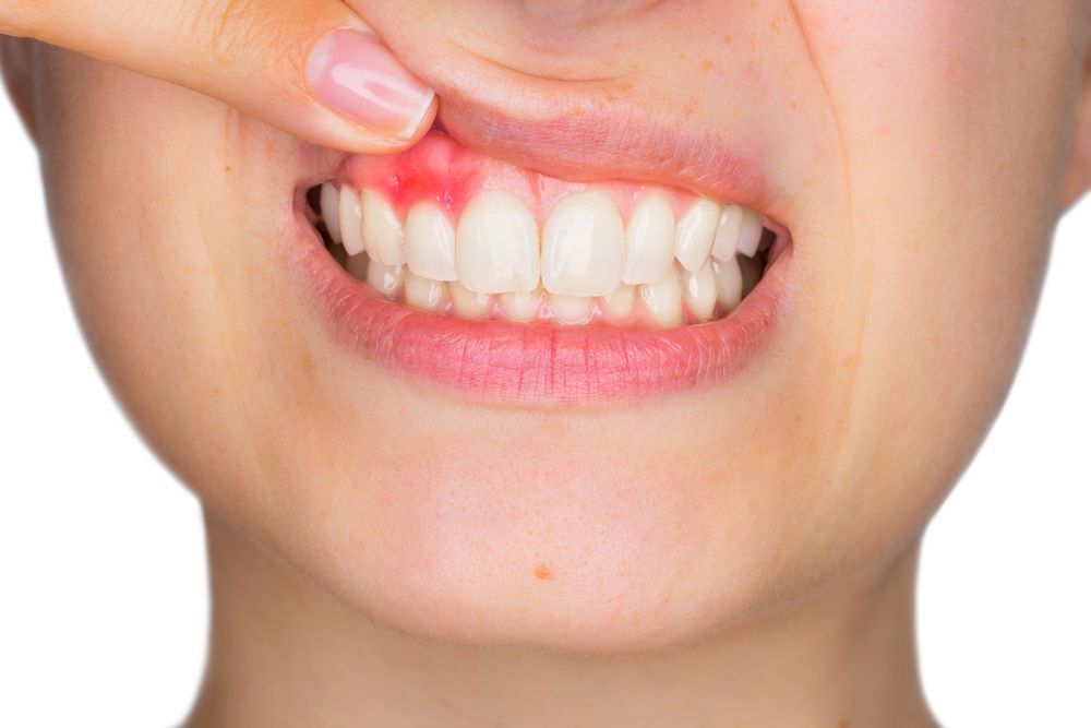 Person's mouth showing inflamed gums, a finger pulls up the lip, revealing red and swollen tissue around the teeth.