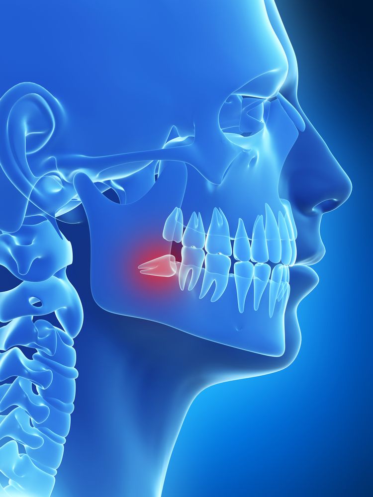 X-ray of jaw with red highlight on impacted wisdom tooth.
