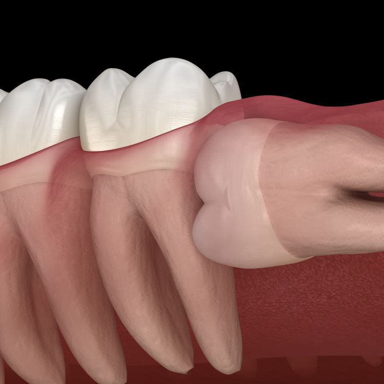 Illustration of an impacted wisdom tooth pushing against a molar, in the jaw.