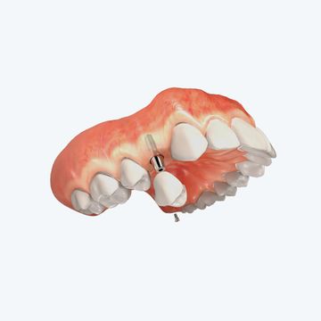 A close up of a denture with a screw in it