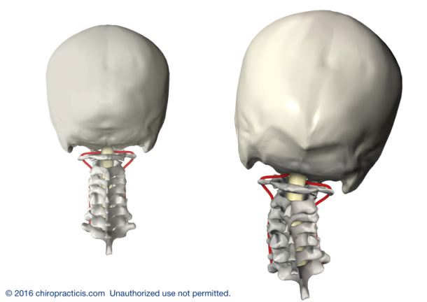 Normal and Subluxated Cervical Spine – Saratoga Springs, NY – IFCO