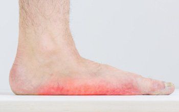 Flat Feet — Flat Feet of A Patient in Orlando, FL