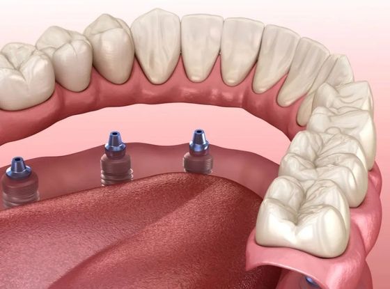 Protesi dentaria in 3D