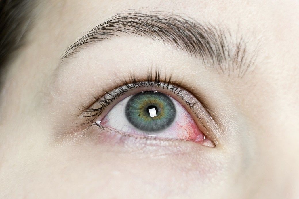 Allergic Conjunctivitis vs. Viral/Bacterial Pink Eye: How to Tell the Difference | South Shore Eye Care