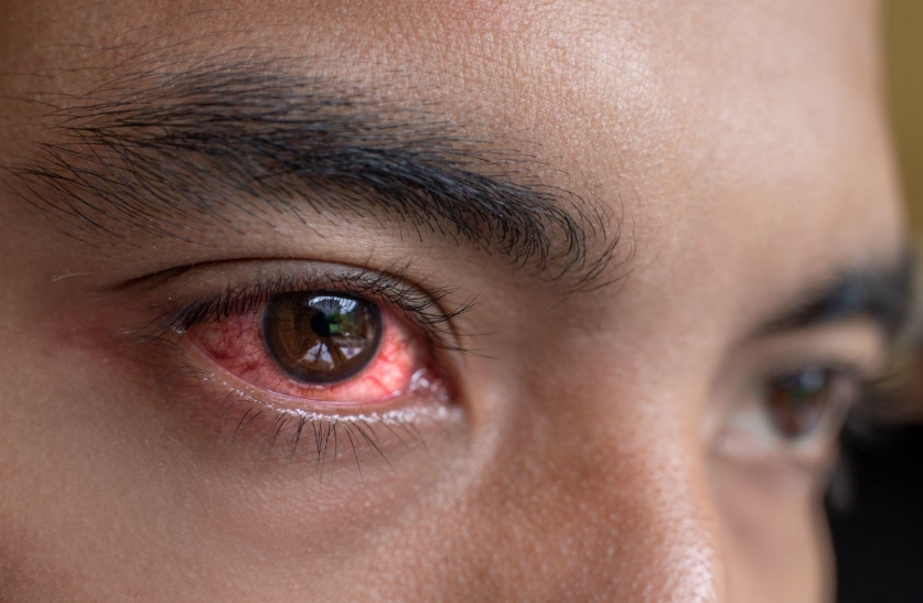 Recognizing and Treating Herpes Simplex Keratitis | South Shore Eye Care, LLP