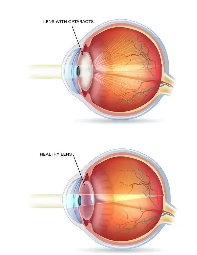 CATARACTS | South Shore Eye Care | Service Page
