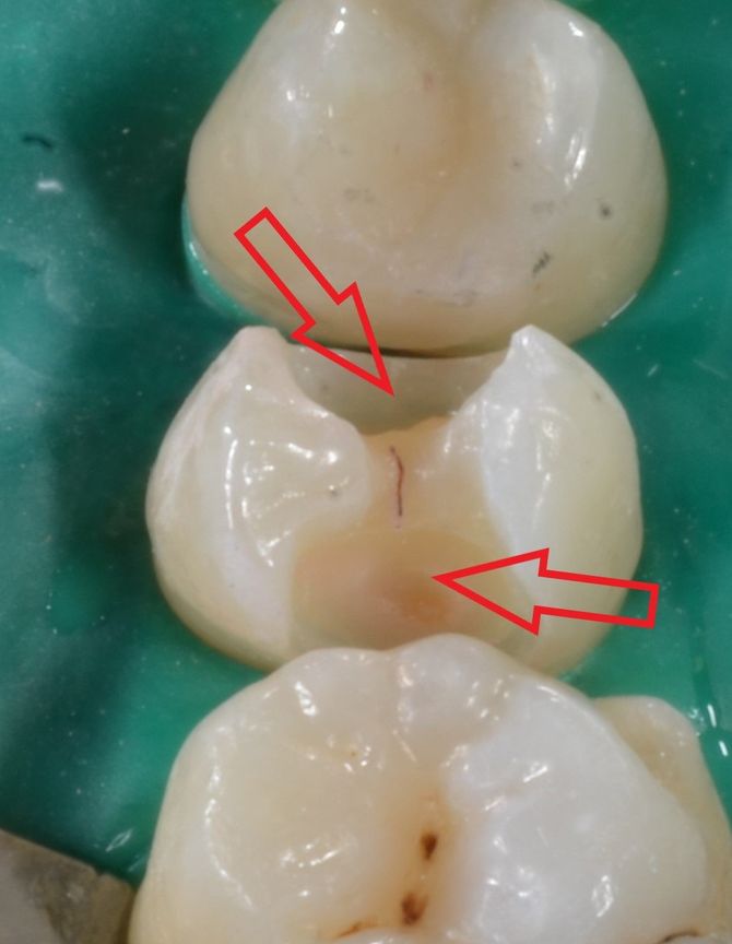 preparazione per cura della carie