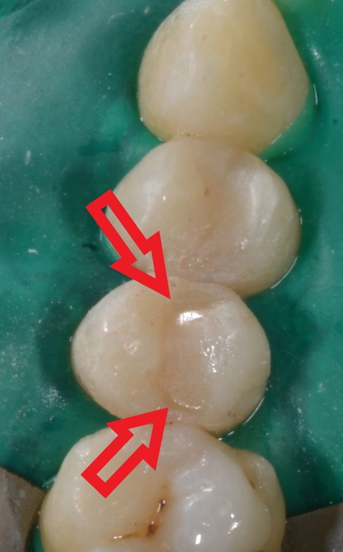 otturazione non ancora rifinita