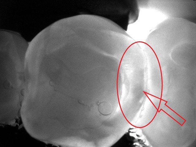 denti molari dopo il trattamento