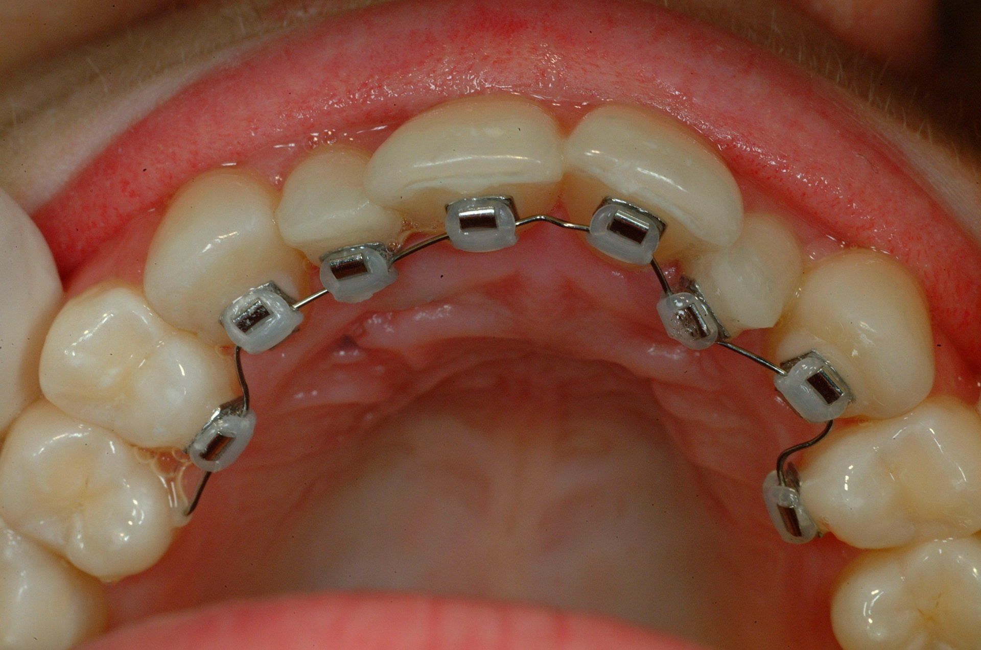 apparecchio dentale interno