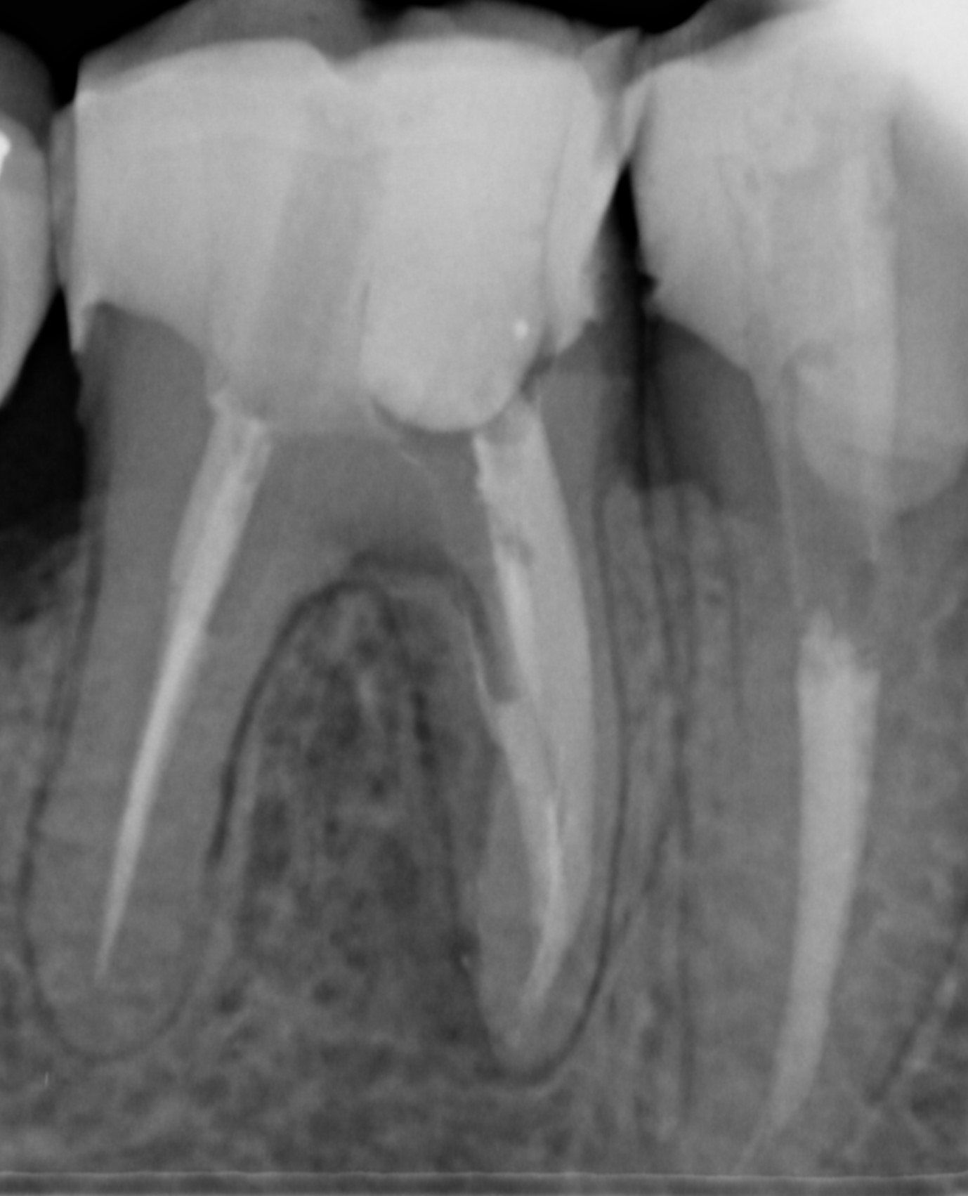 radiografia molari dopo