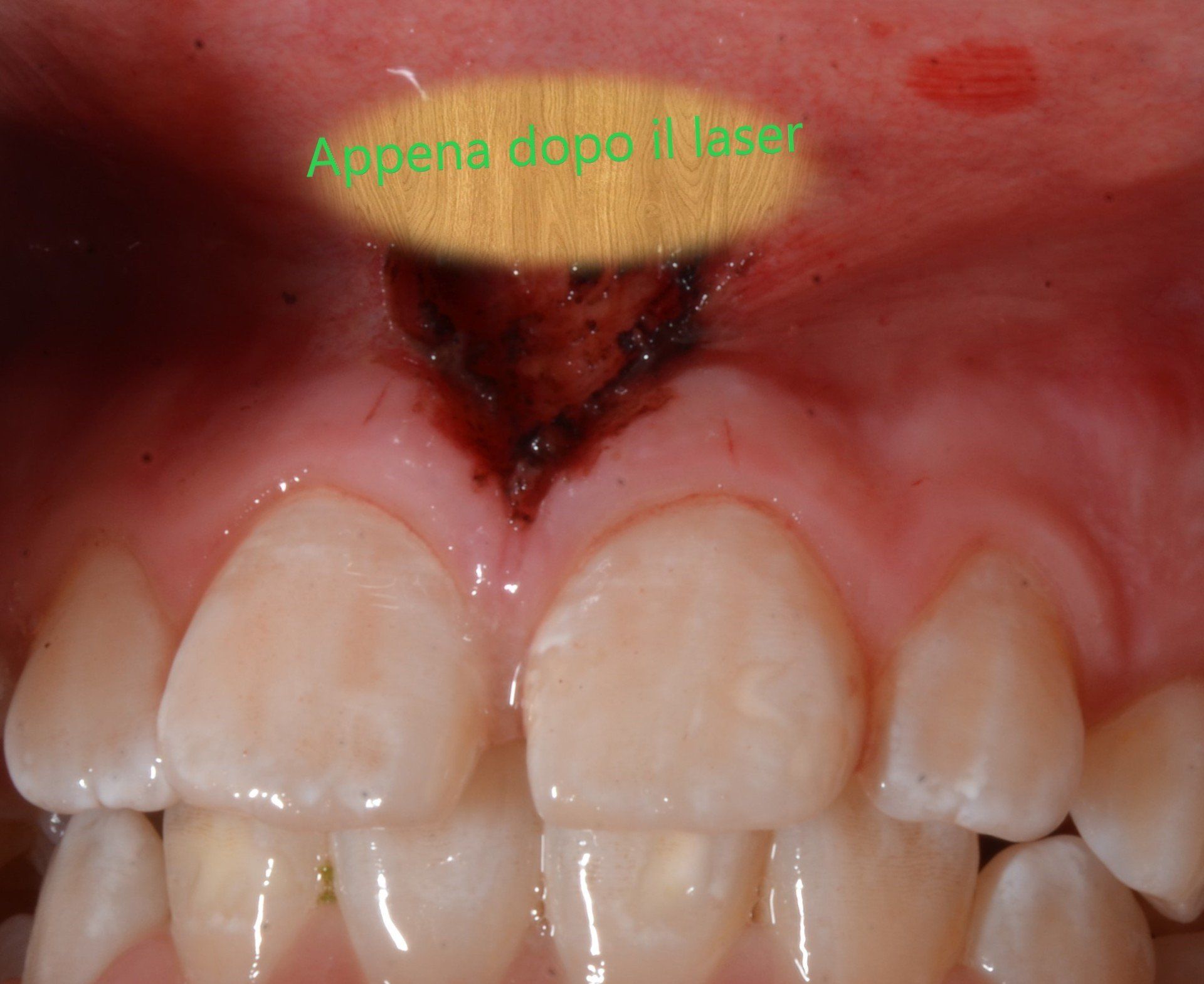 denti dopo il trattamento