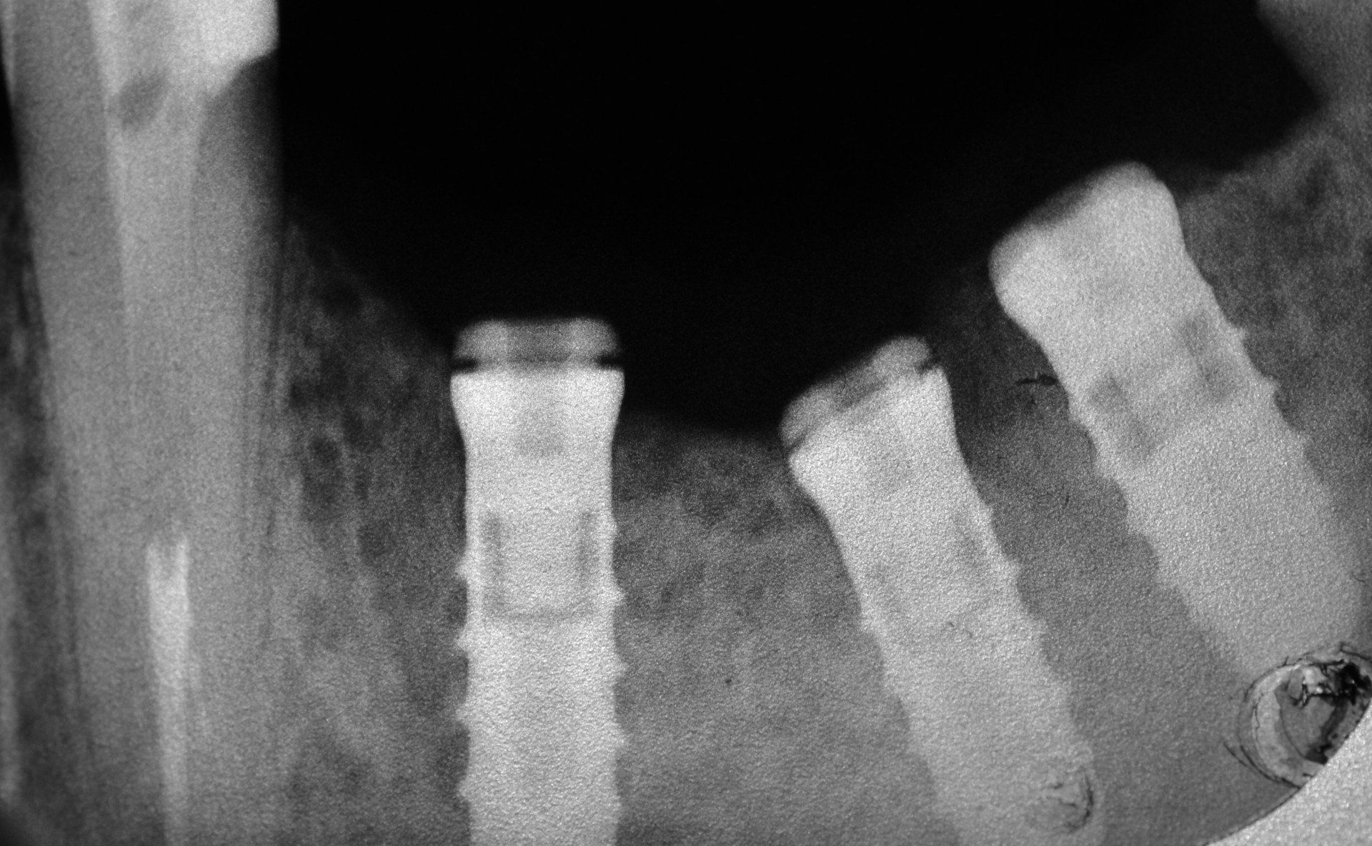 radiografia dentale prima