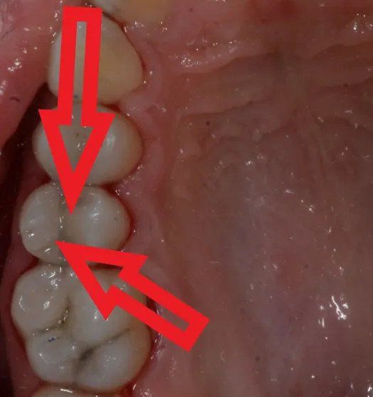 intervento per la cura della carie
