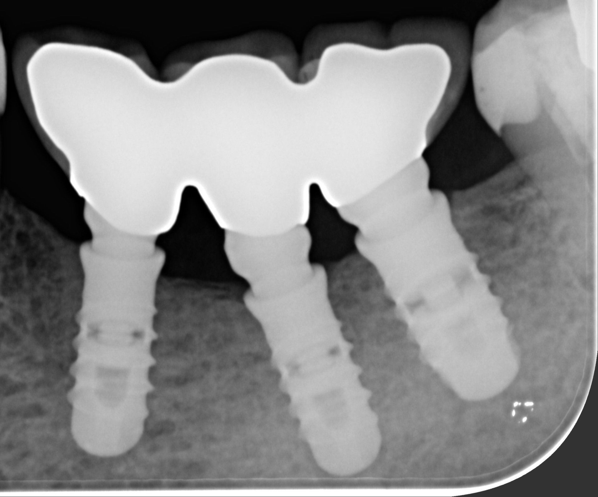 radiografia dentale dopo
