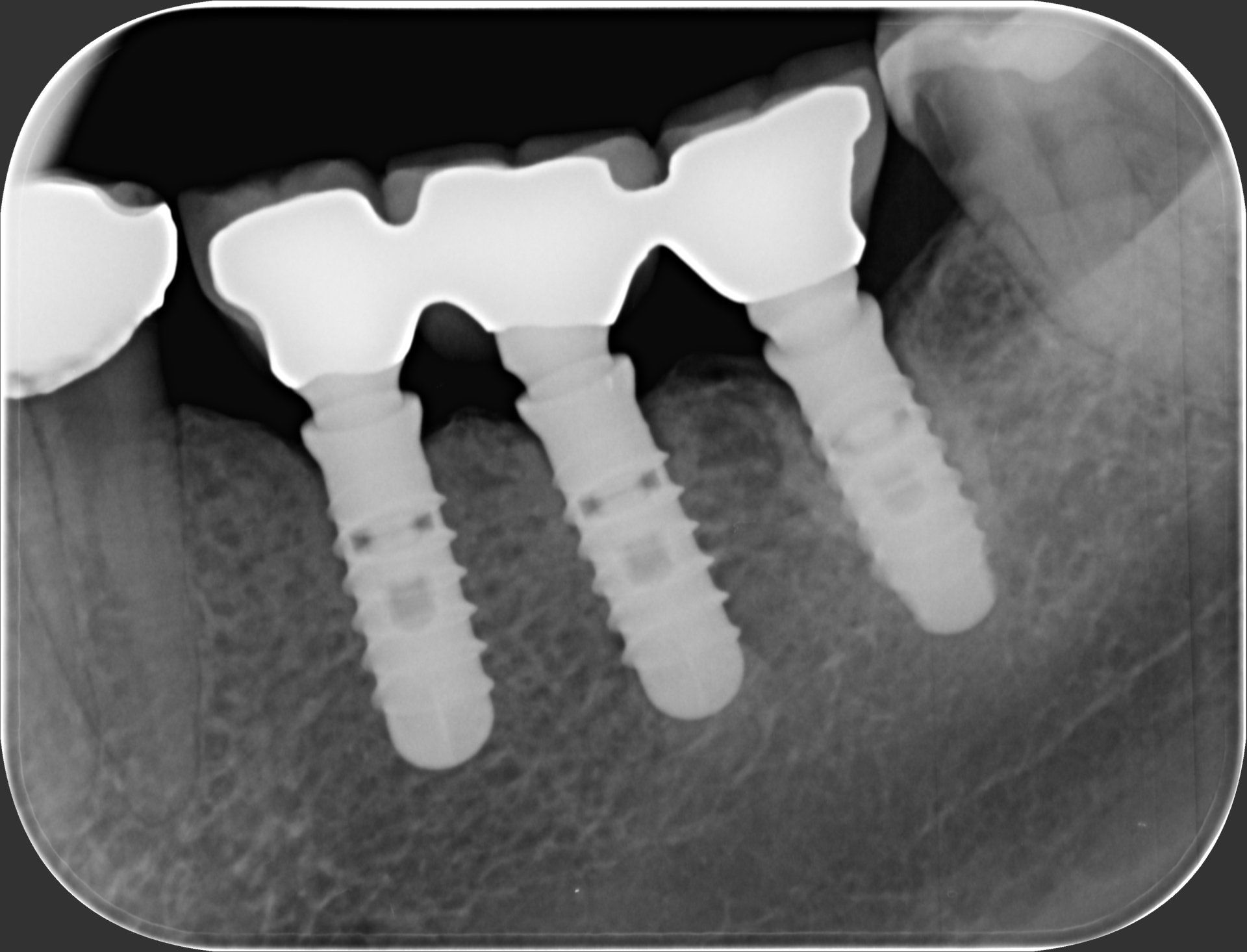 radiografia dopo un impianto dentale