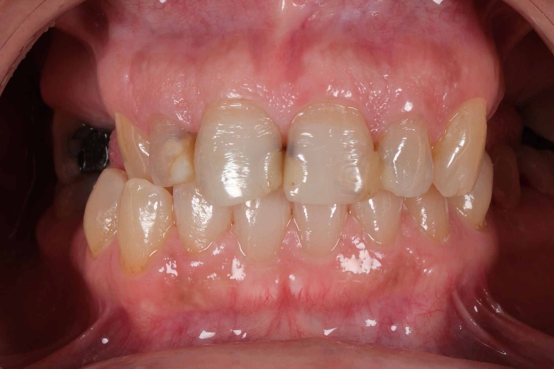 A close up of a person 's teeth and mouth.