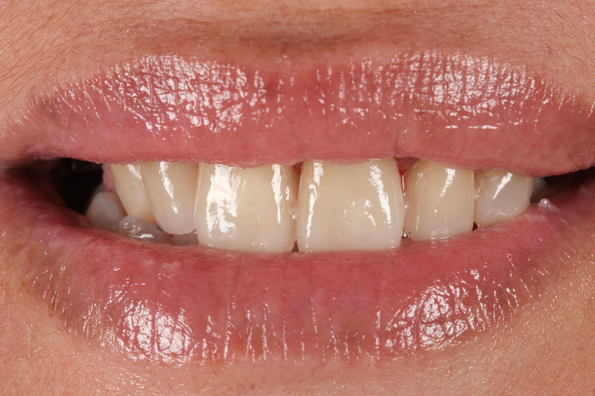 A close up of a woman 's mouth with white teeth.