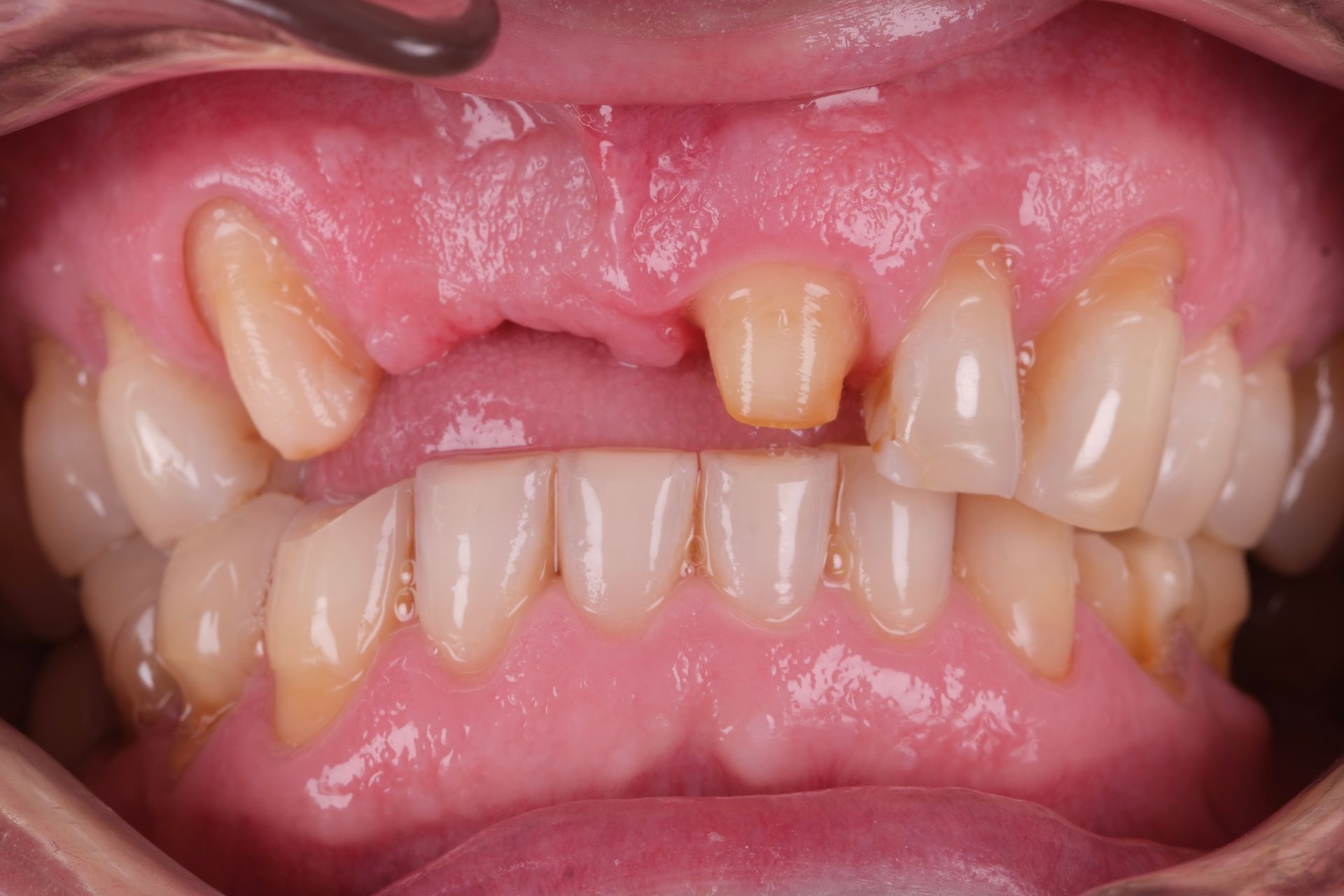 A close up of a person 's mouth with missing teeth.