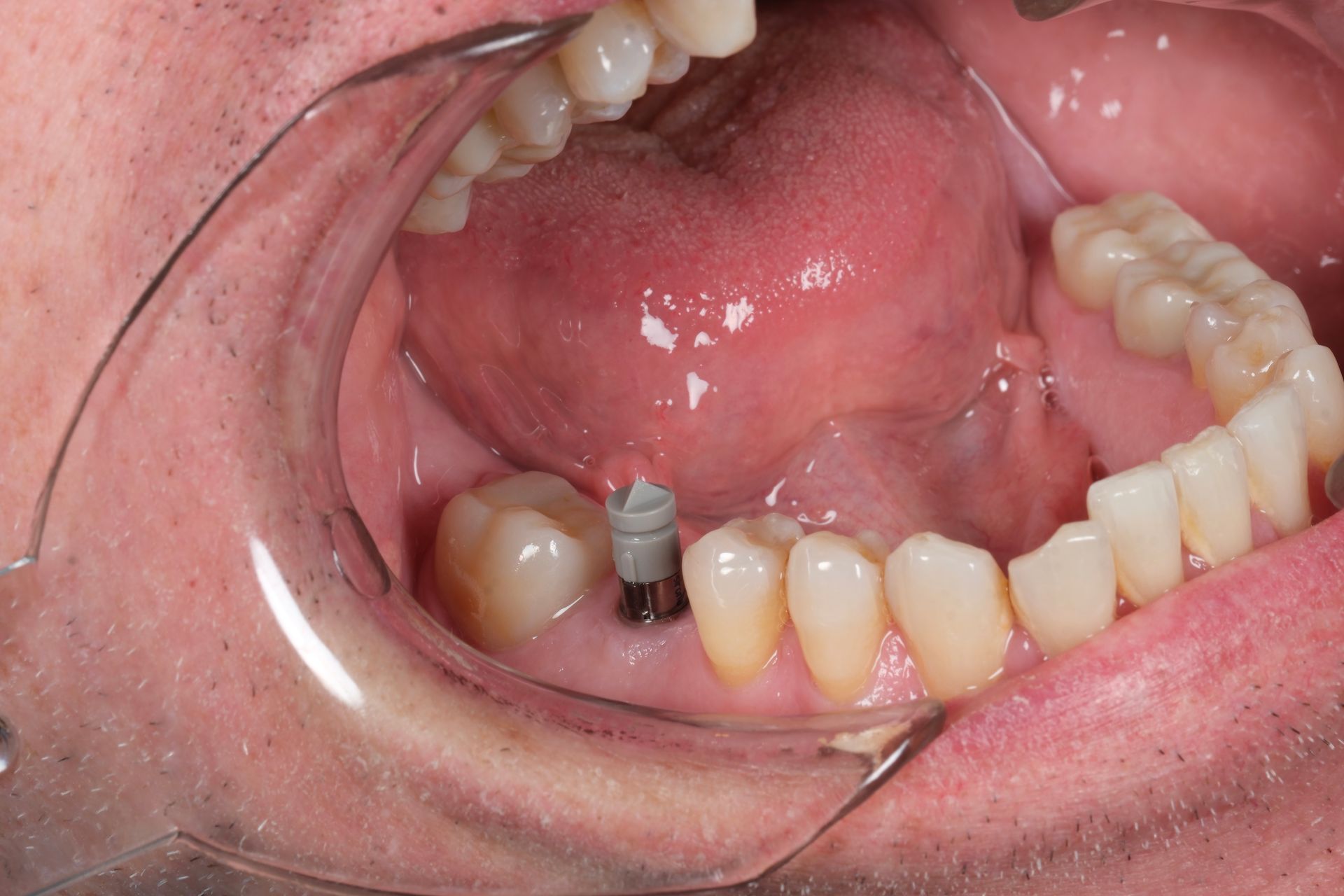 A close up of a person 's mouth with a dental implant in it.