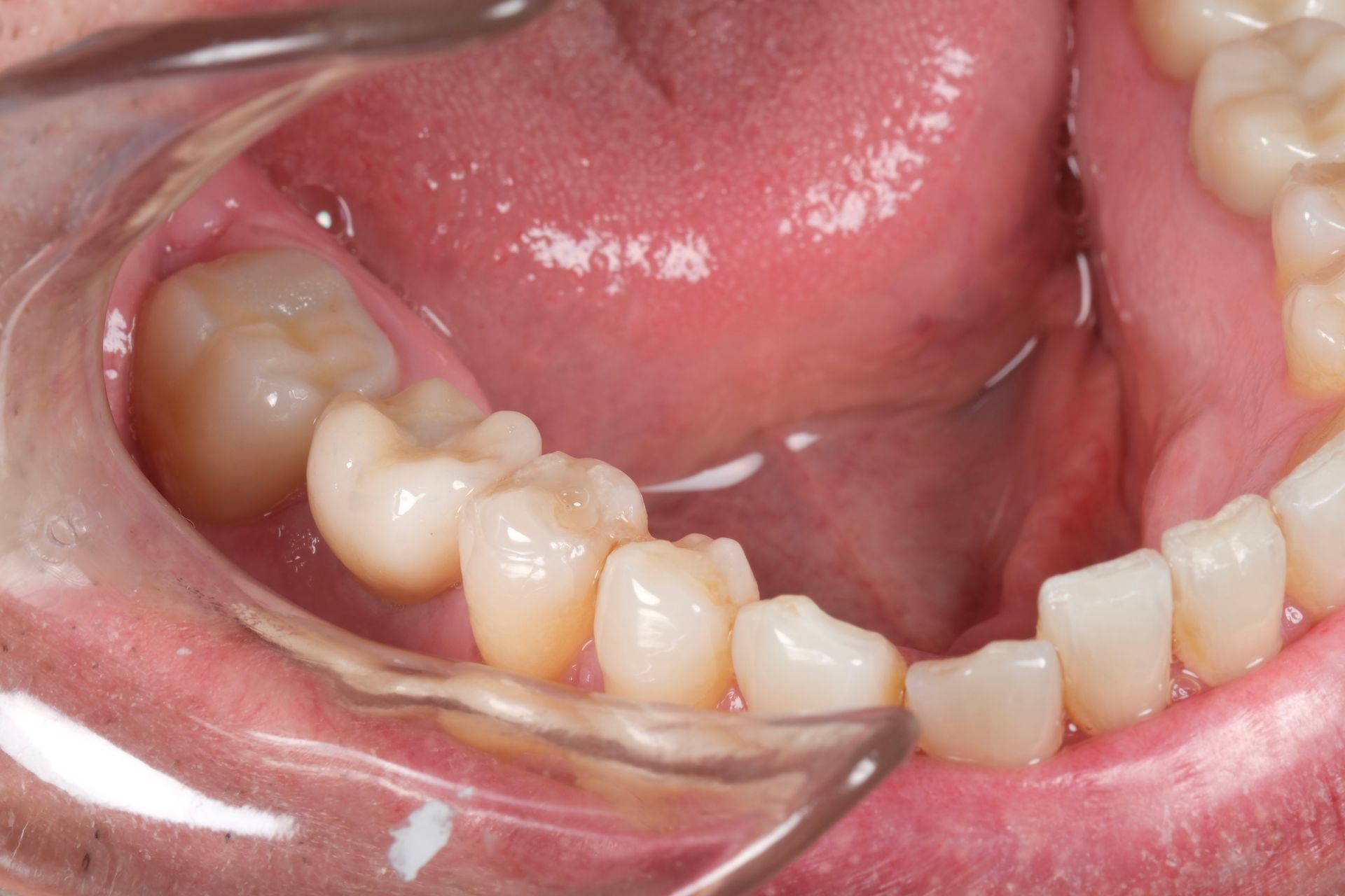 A close up of a person 's teeth with a mouth guard.
