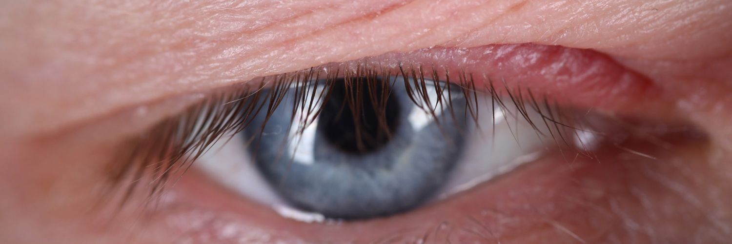 Une boule sur la paupière qui persiste ? Découvrez ce qu’est un chalazion, ses causes, les traitemen