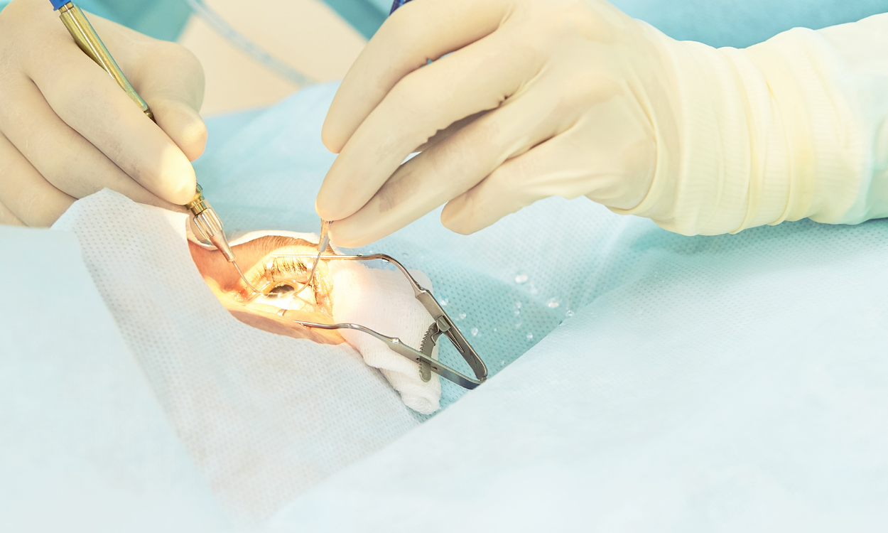 laser des yeux operation
