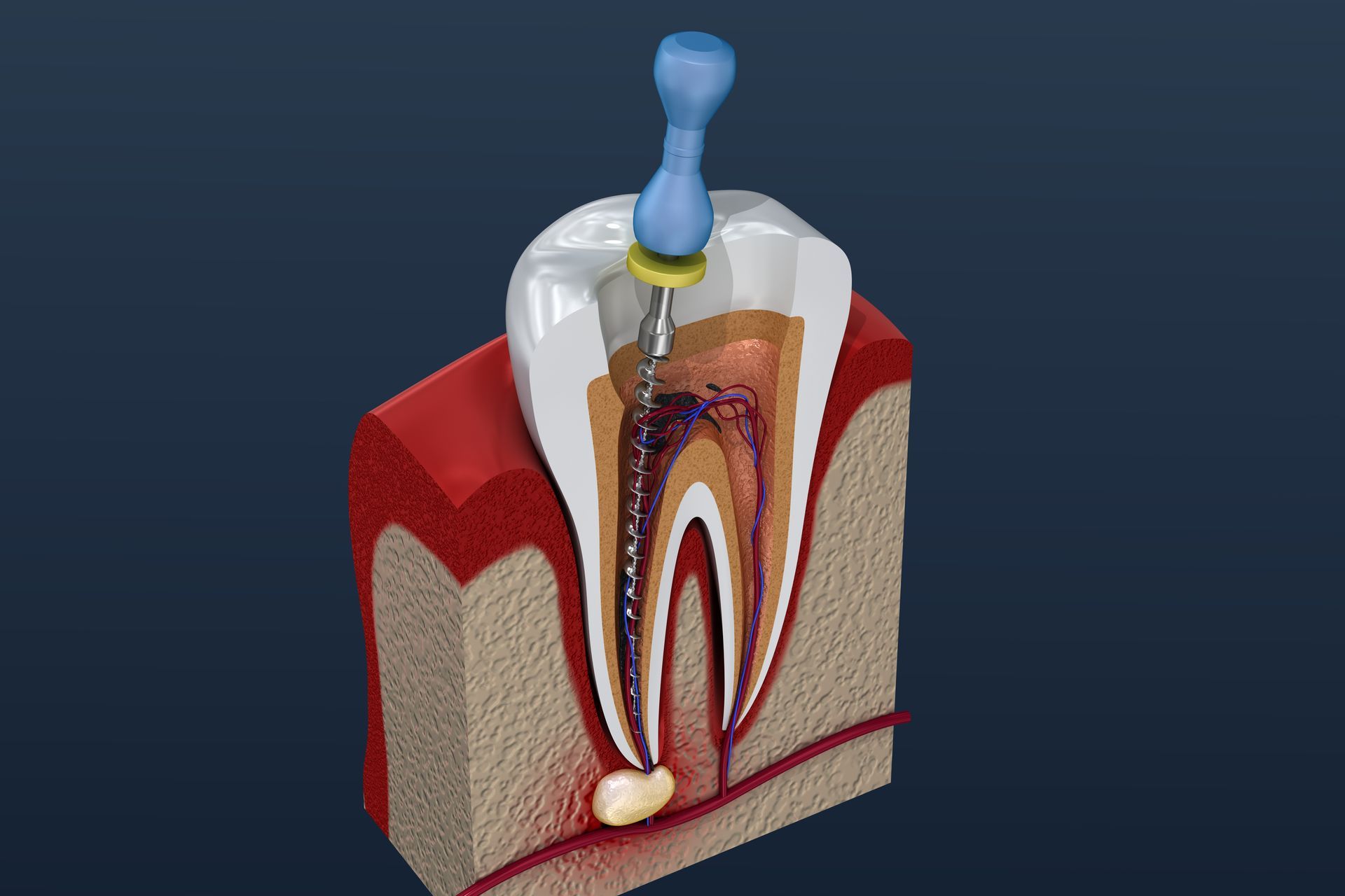 Un modèle 3D d'une dent avec une perceuse dedans.