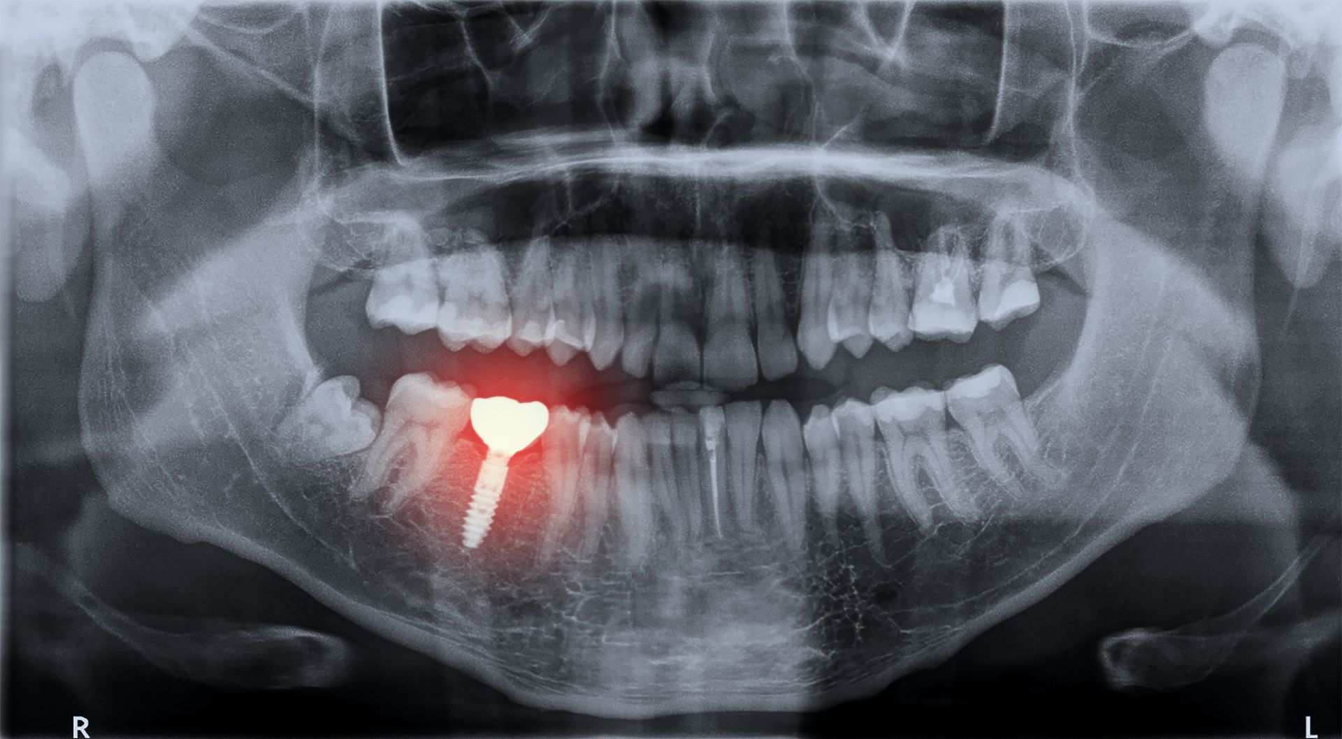 Une radiographie des dents d'une personne à qui il manque une dent.