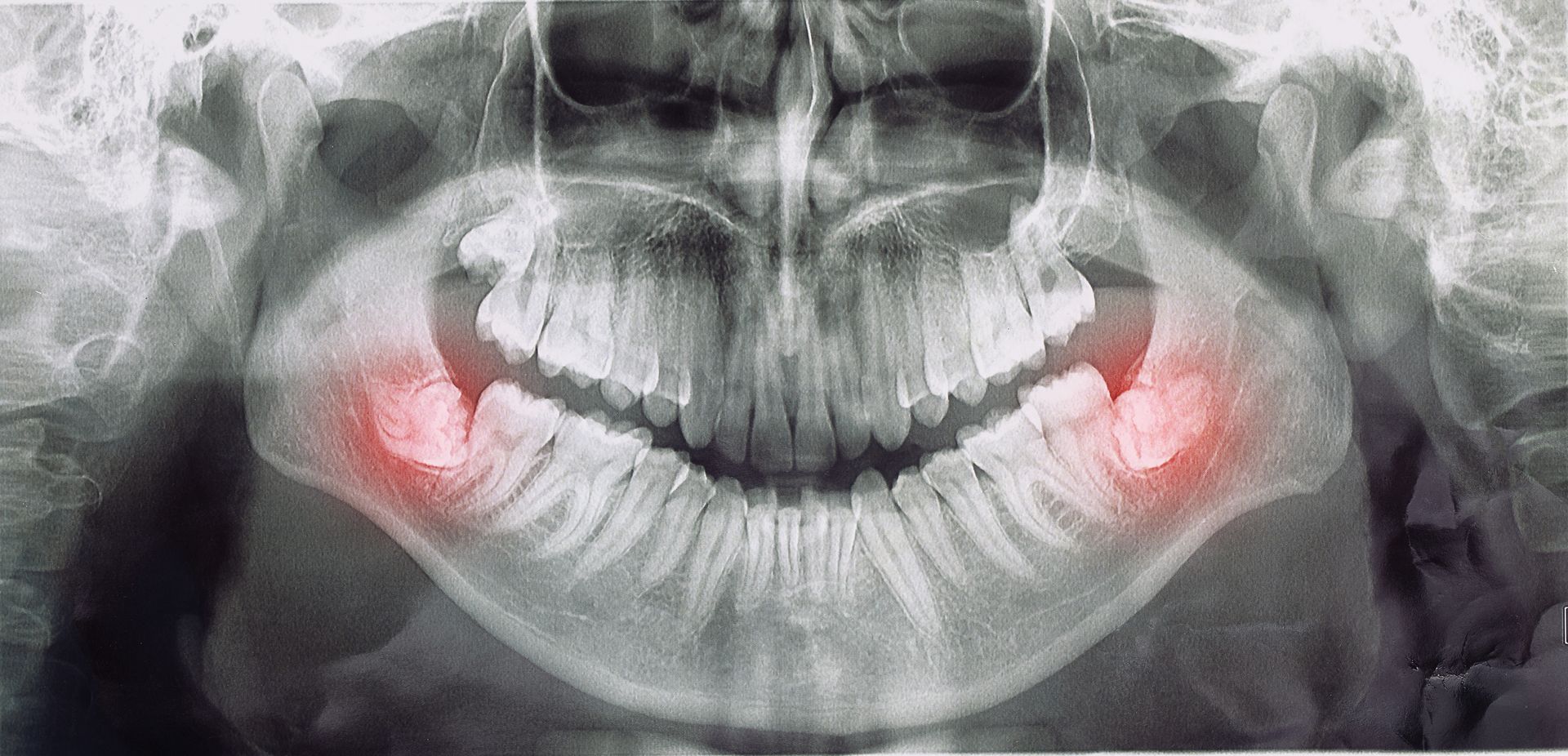 Une radiographie des dents d'une personne montrant une grande dent de sagesse.