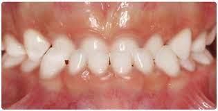 Un gros plan des dents d'une personne avec des dents blanches.