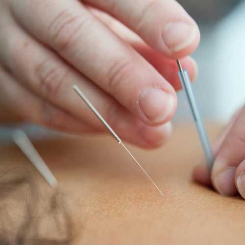 Hands inserting acupuncture needles into skin.