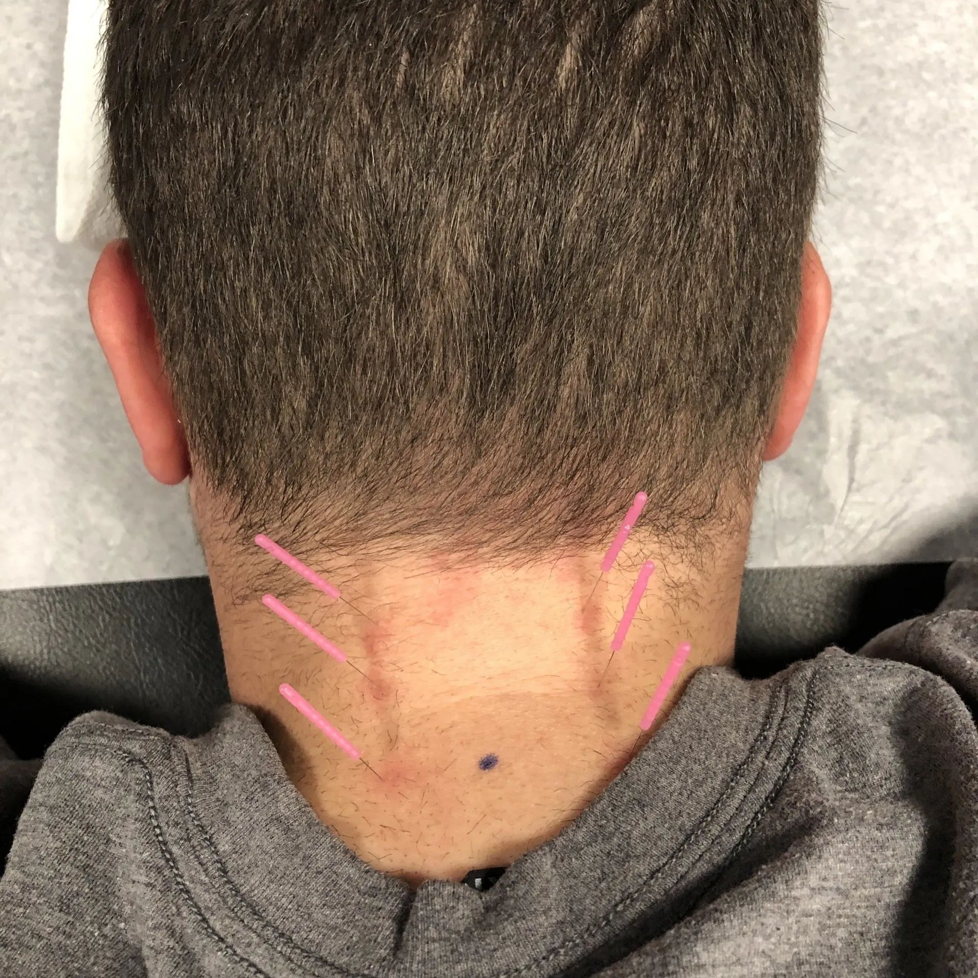 Back of a person's neck with pink lines indicating acupuncture needles placed in the skin.
