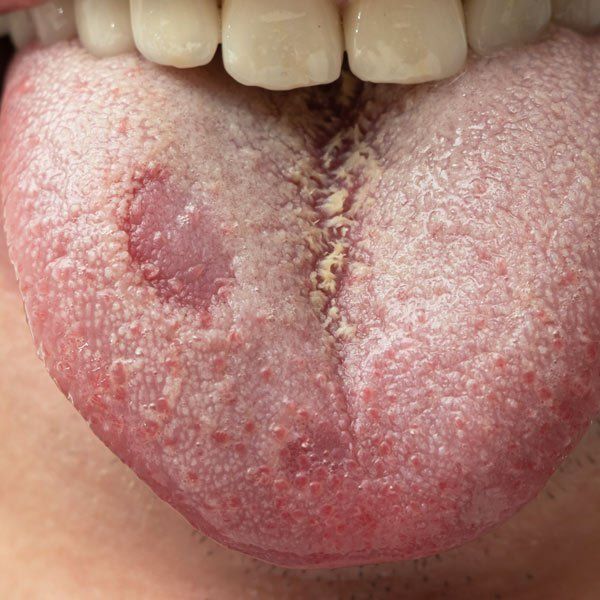 Man with a Candida Infection on his tounge