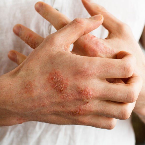 Woman with Eczema scratching her hands